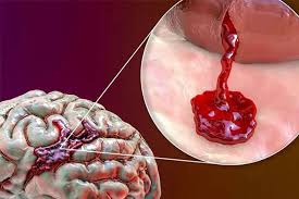 خونریزی مغزی